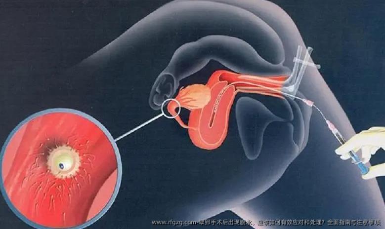 卵泡取出手术后出现腹水，应该如何有效应对和处理？全面指南与注意事项